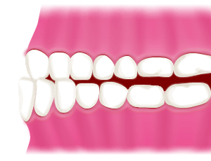 特に受け口(下顎前突)と交叉咬合は早めにご相談を