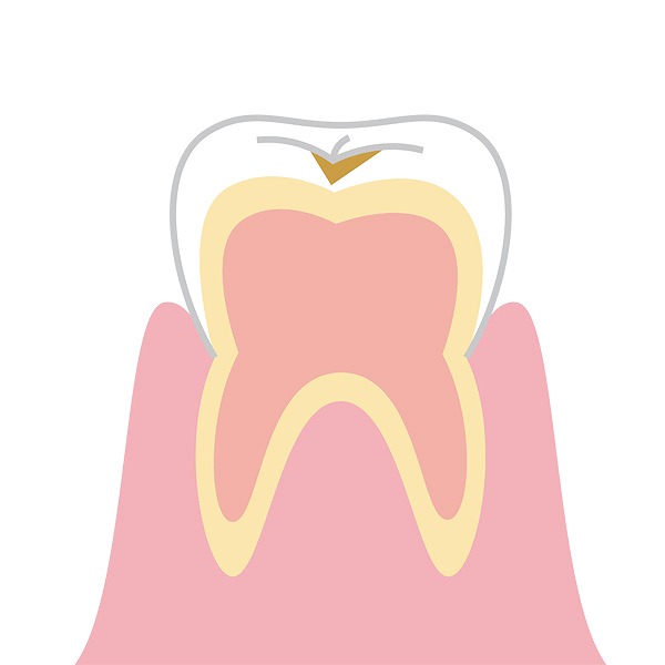 エナメル質を表面的に溶かした虫歯