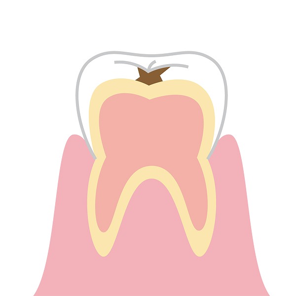 エナメル質に穴をあけた虫歯