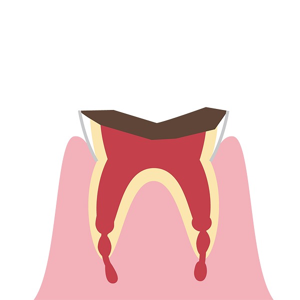歯の根っこまで進行した虫歯