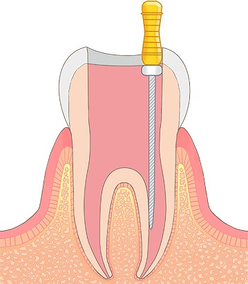 根管治療