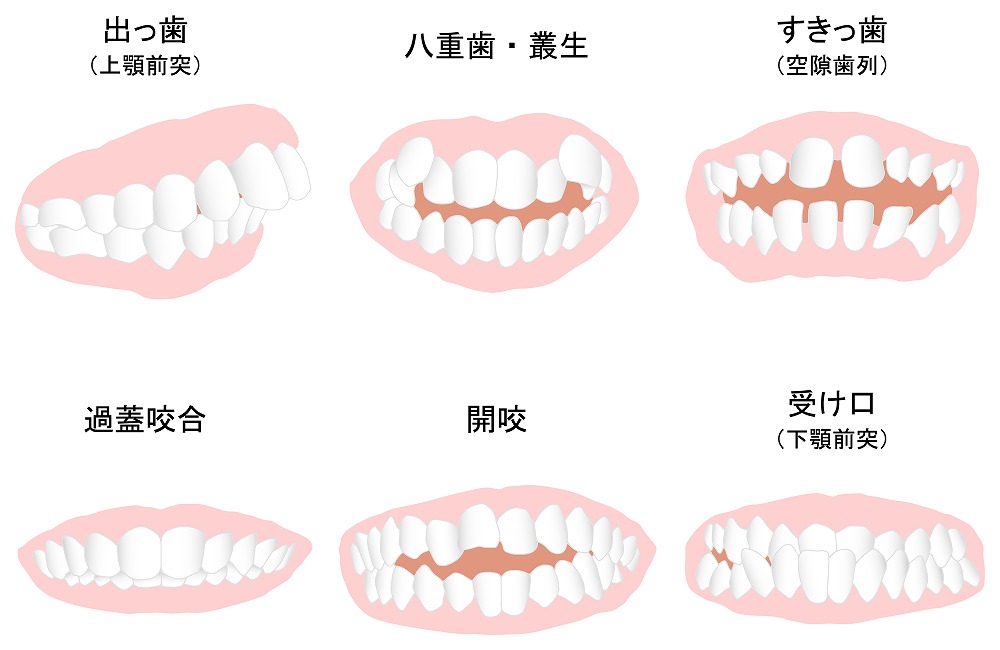 歯並びでのお悩み