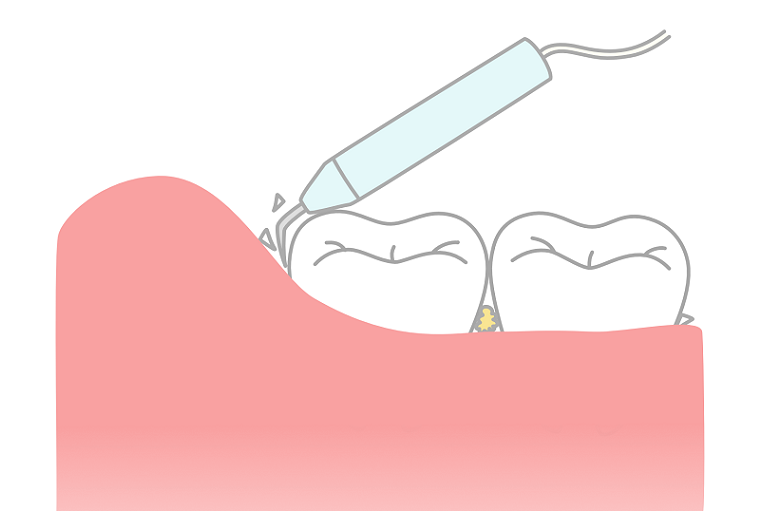 歯垢(プラーク)が石灰化したのが歯石